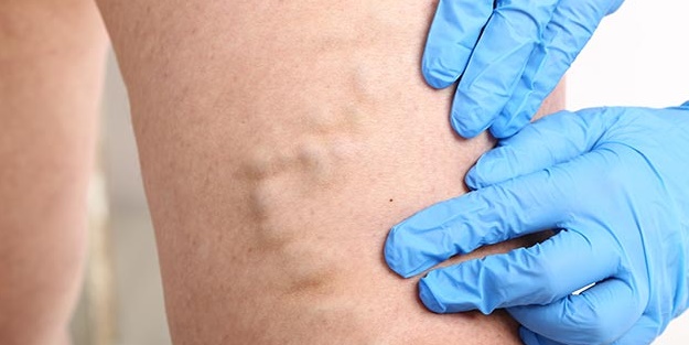 Basit önlemlerle varisten korunmak mümkün mü?