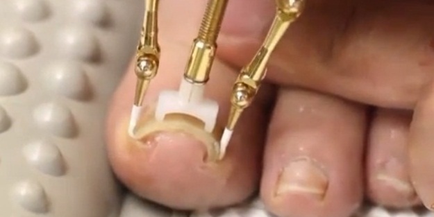 Batık tırnak nasıl düzeltilir? - VIDEO