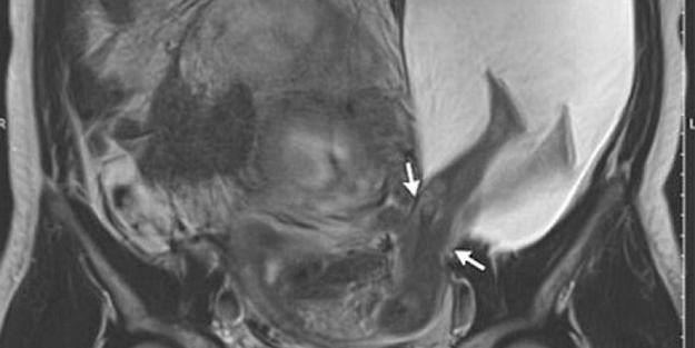Bebeğin ayakları rahimden dışarı çıktı!
