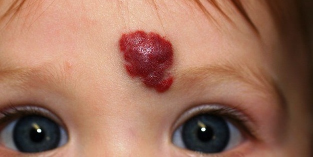 Bebeğinizde bu belirti varsa dikkat