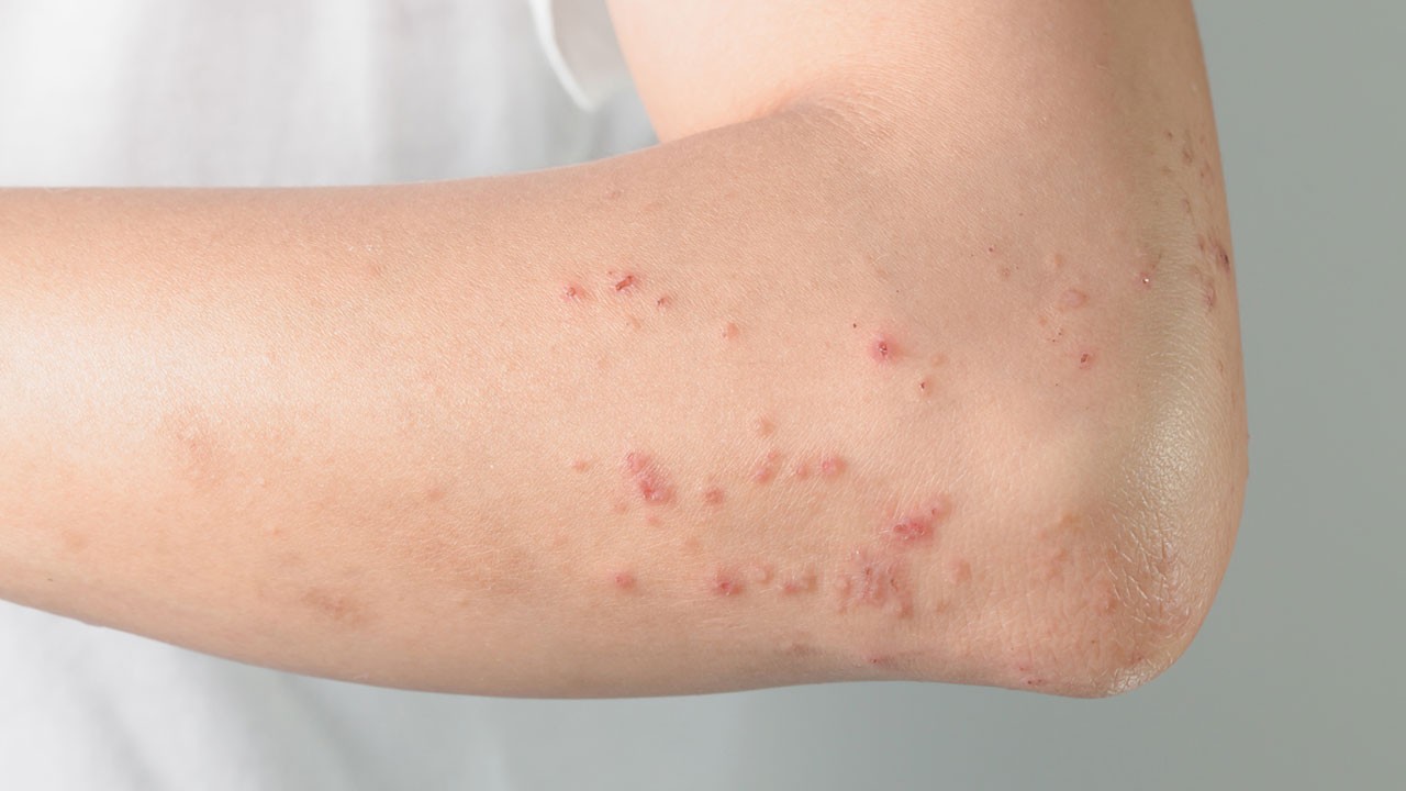 Behçet hastalığı nedir, tedavisi var mı?