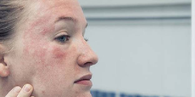 Besin alerjisi nedir? Hangi besinler alerji yapar?