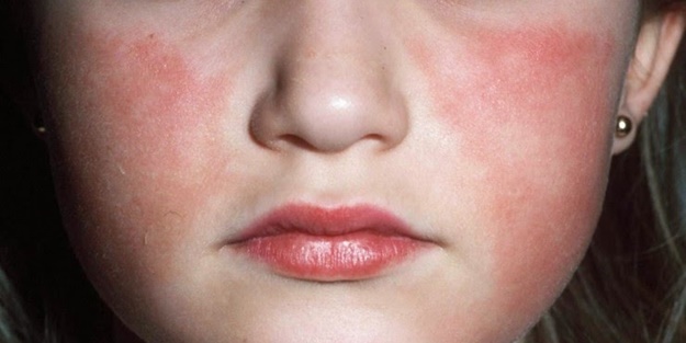 Beşinci hastalık nedir?