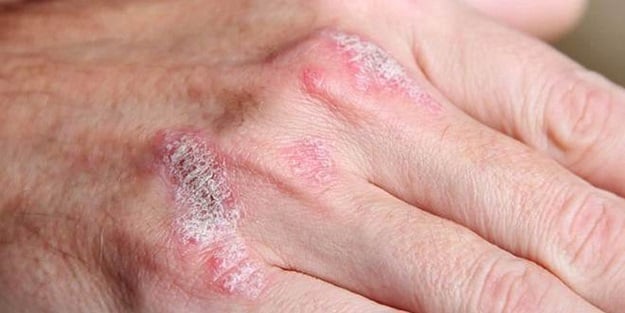 Beta mikrobu, sedef hastalığına neden olabilir