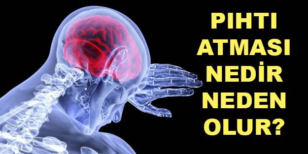 Beyin damarında pıhtı atması nedir? Beyin damarında pıhtı atması neden olur belirtileri neler?