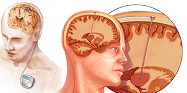 Beyin pili; birçok hastalığa çözüm oluyor