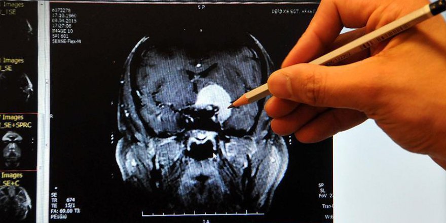 Beynin şekli, kişilik farklarını belirliyor