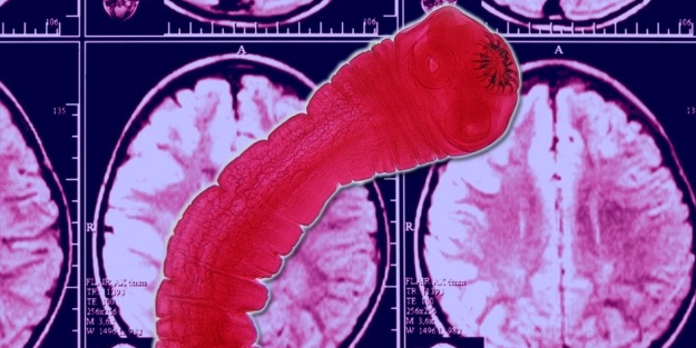 Beyninden bağırsak solucanı çıktı