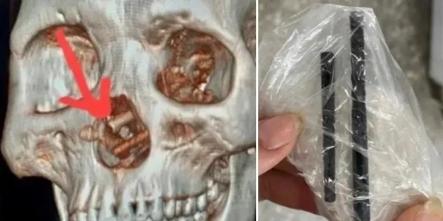 Beynine saplanmış yemek çubuklarıyla 5 ay yaşamış!