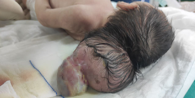 Beyninin yarısı kafatası dışında dünyaya geldi