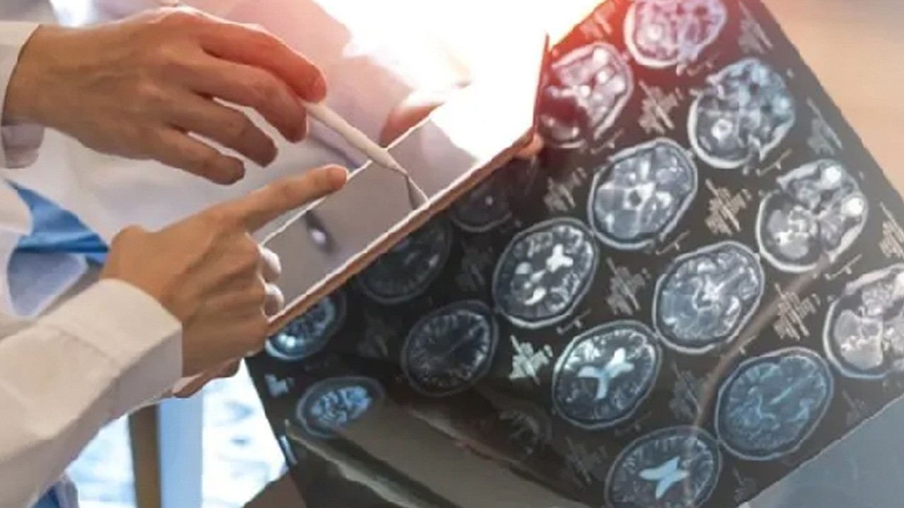 Beyniniz sessizce ölüyor olabilir! Bunu hiç kimse bilmiyor