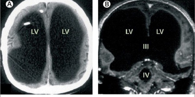Bilim dünyası “beyinsiz” insanın şaşkınlığını yaşıyor