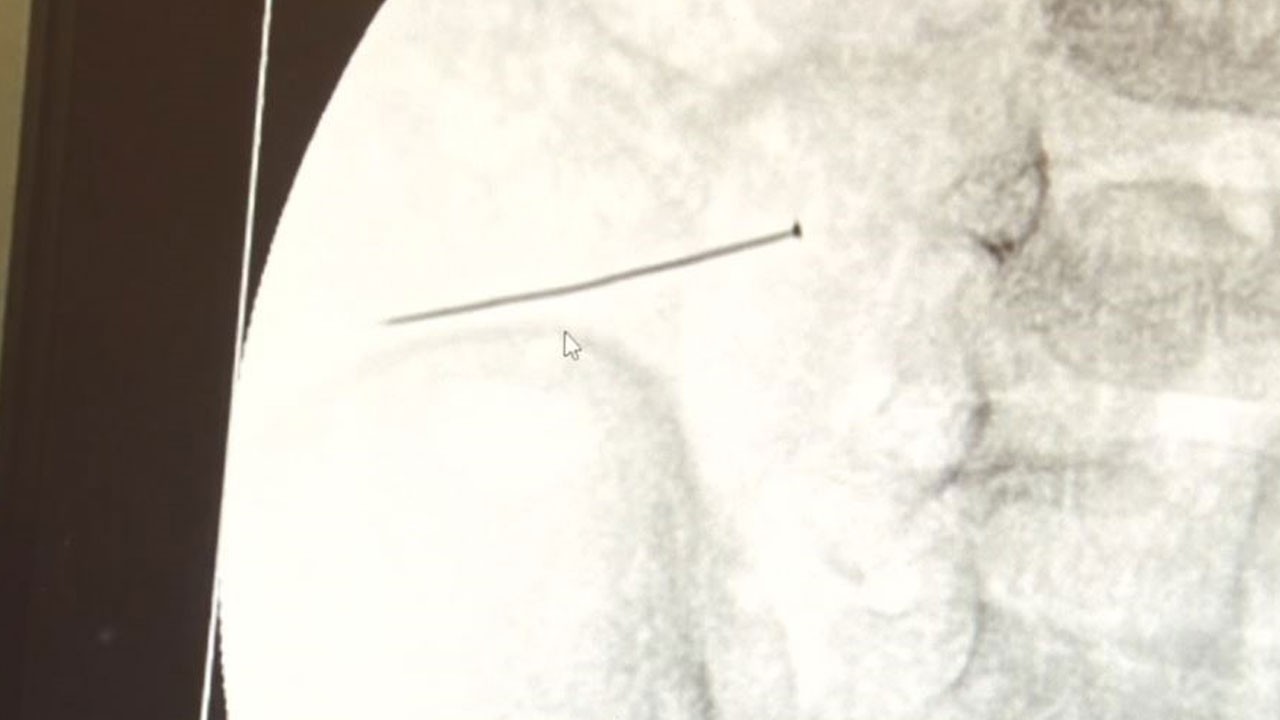 Bir anlık hata az daha canına mal oluyordu! 2 yaşındaki çocuğun bağırsakları delindi