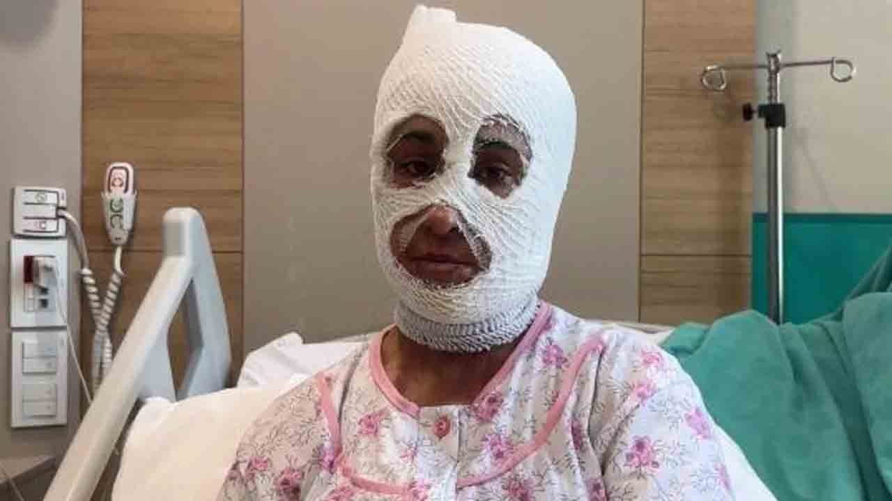 Bir anlık ihmal, ağır bedel: Genç kadın yanıklarla hastanede