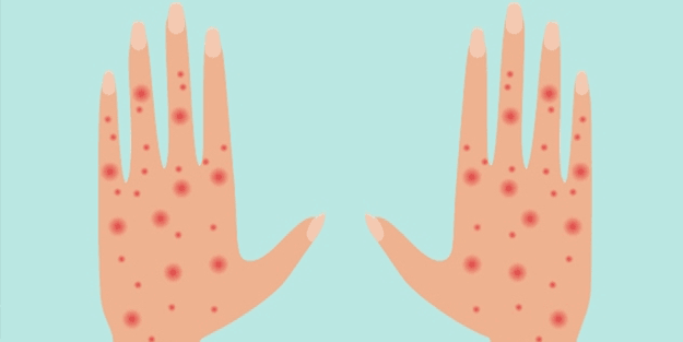 Bir bu eksikti! Uyuz ile ilgili korkutan sözler