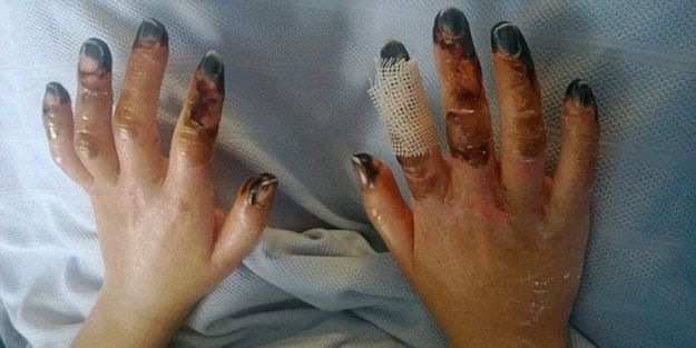 Bir günde parmakları bu hale geldi