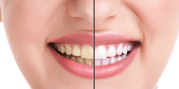 Bir haftada dişleri bembeyaz yapıyor!
