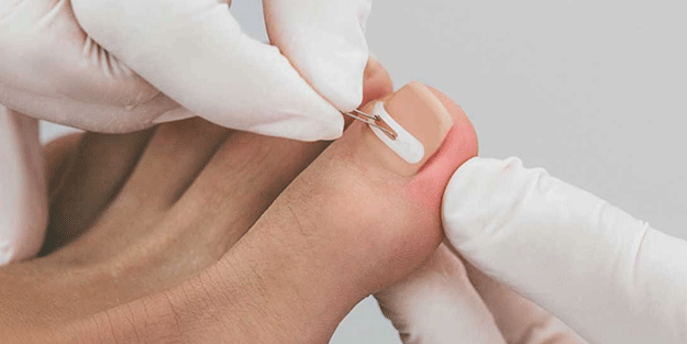 Birçok kişinin başına geliyor İşte tırnak batmasını önlemenin 5 yolu!