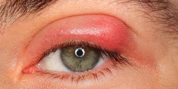 Blefarit nedir? Tedavisi nelerdir?