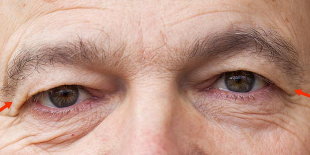 Blefaroşalazis nedir tedavisi nasıl olur?