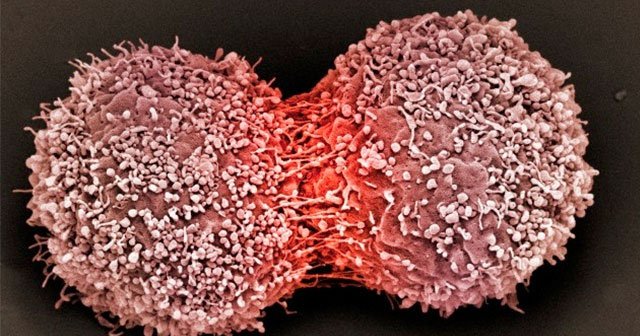 BM: Kanserden her yıl 7,6 milyon kişi ölüyor