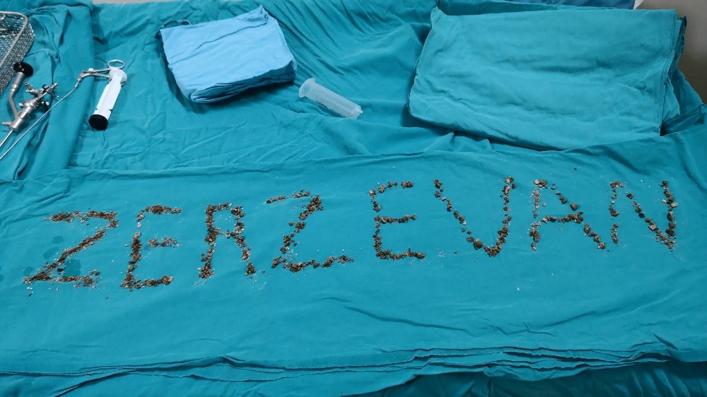 Böbreğinden ’Zerzevan’ çıktı 