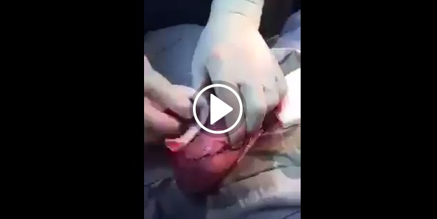 Böbrek taşı deyip geçmeyin!