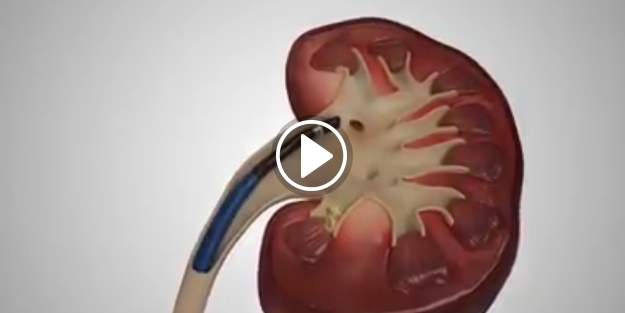 Böbrek taşı nasıl çıkarılır?