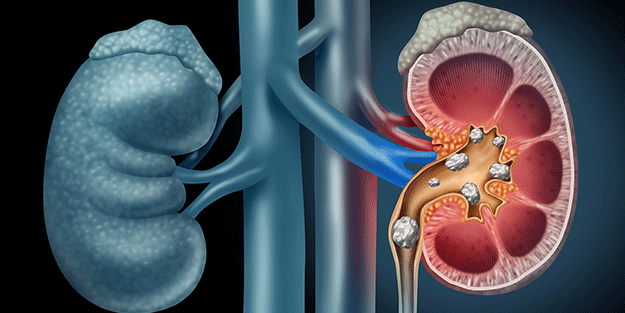 Böbrek taşı olanlar dikkat! Birçok hastalığın habercisi olabilir