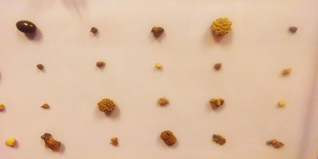 Böbrek taşını önlemek için alınacak tedbirler