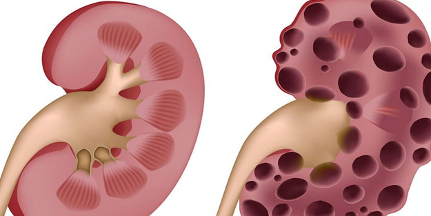 Böbrek tümörü belirtilerine dikkat! Böbrek kanseri riskini artıran faktörler