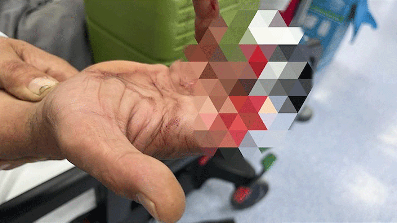 Bodrum dönüşünde korkunç kaza! Parmağı kopan kadın 5,5 saatte kurtarıldı