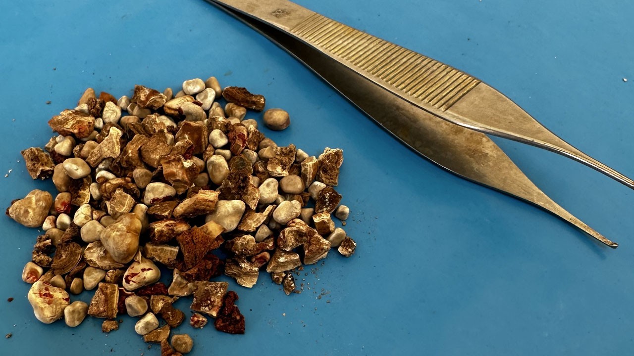 Böyle bir şey görülmedi! Hastanın böbreklerinden 300’den fazla taş çıktı