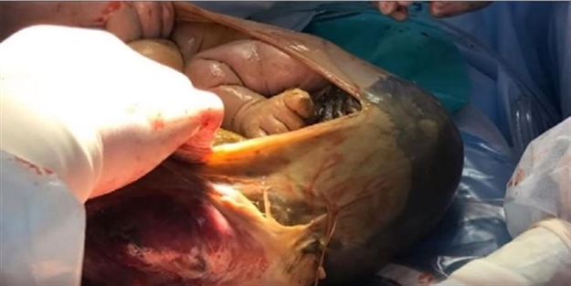 Böyle doğum 625 milyonda bir görüldü!