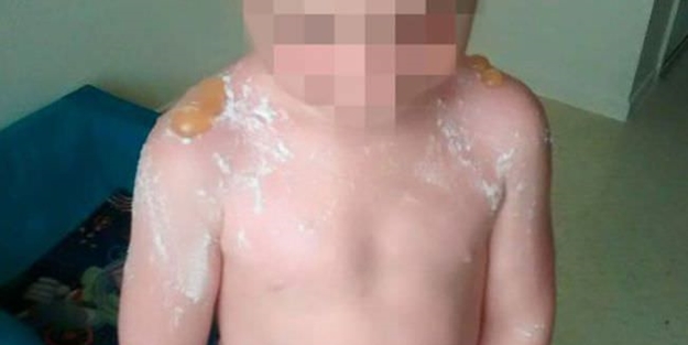 Böyle güneş yanığı görülmedi! - FOTO