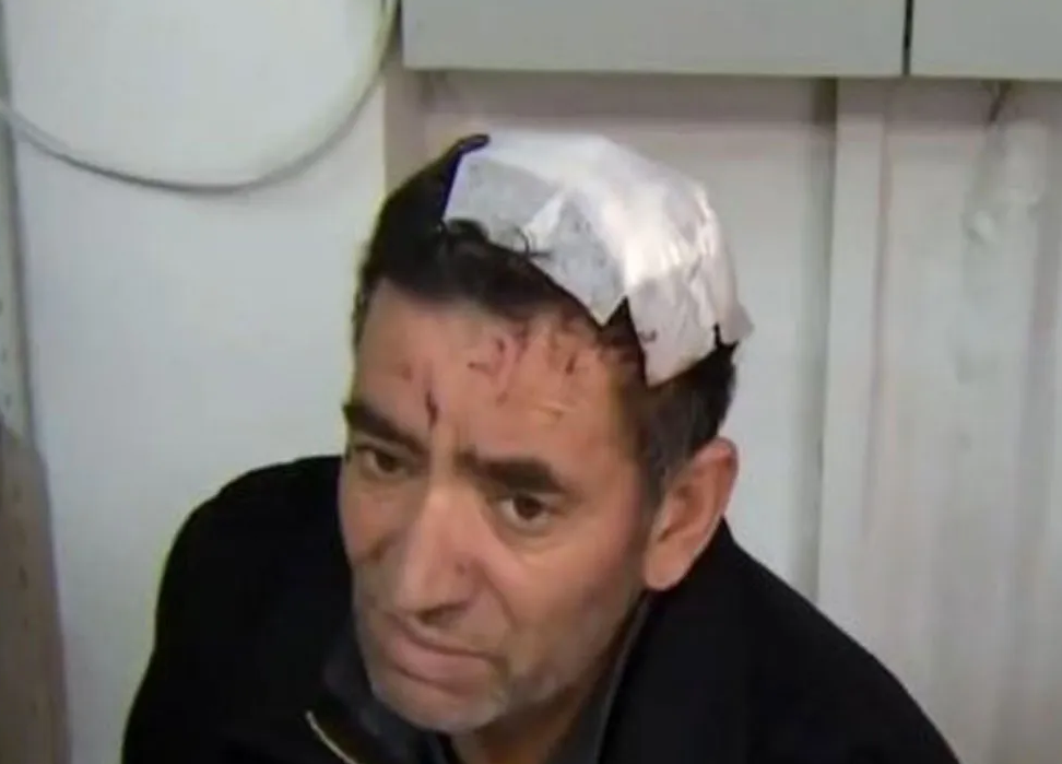 Böylesi daha önce olmadı! Amcasının kafa derisini yüzdü! Sebebi, herkesi şoke etti