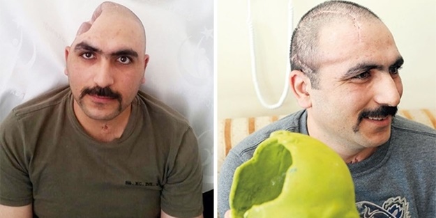 Böyleydi... Kafatasına 3D teknolojisiyle kavuştu