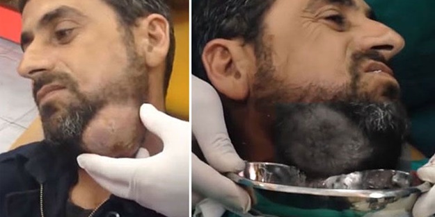 Boynundaki kitleye neşteri vurunca gözlerine inanamadılar!
