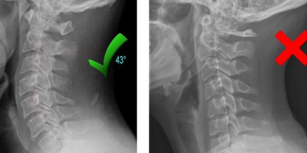 Boyun düzleşmesi geçer mi? Boyun düzleşmesine karşı uzmanlar uyarıyor!