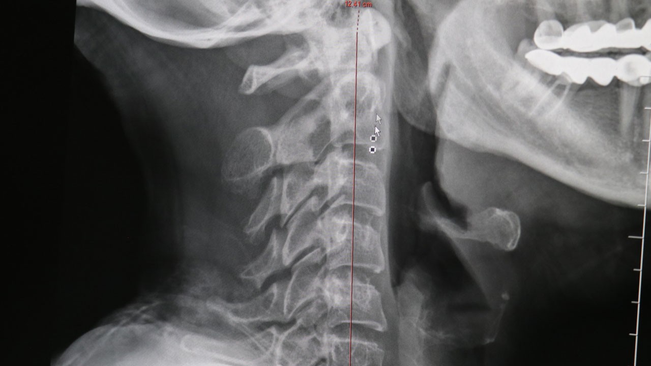 Boyun fıtığı ilkokul çağında! Teknoloji bağımlılığı felce kadar götürebilir