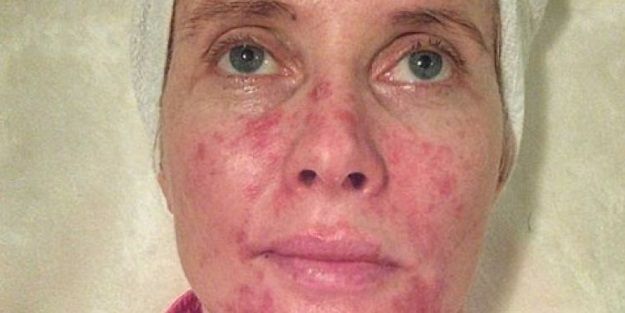 Bronzlaşmak istedi ama...