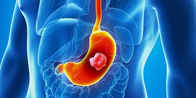 Bu 5 belirtiye dikkat! Mide kanseri olabilirsiniz