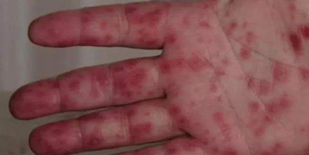 Bu 5 belirtiye dikkat... Yeni salgının adı: Domates gribi!