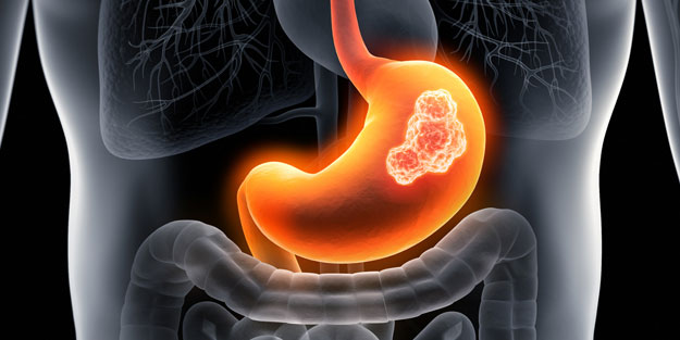 Bu 8 belirti kanser habercisi olabilir