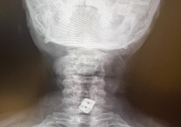 Bu ameliyat Türkiye'de yapıldı! Tıp literatüründe ender görülen olay