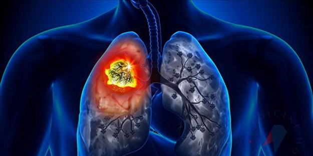 Bu belirtiler varsa… Akciğer kanserinin 8 sinyali