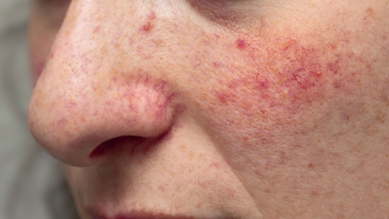 Bu belirtilere dikkat edin! Yüzde aniden başlıyor, yıllarca sürebiliyor