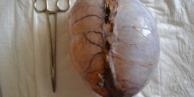 Bu bir insanın karnından çıktı!