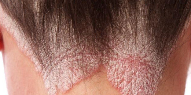 Bu bitki egzama ve sedef hastalığına iyi geliyor! Kuşotu lapası ve serçe dili çayı yapabilirsiniz!