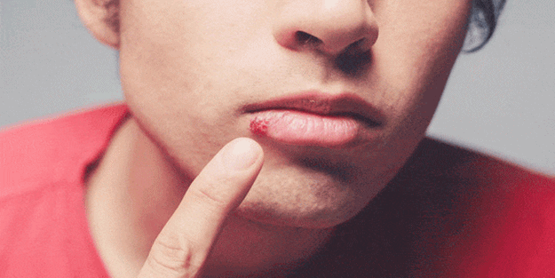 Bu bitkilerle uçuktan kurtulmak mümkün!